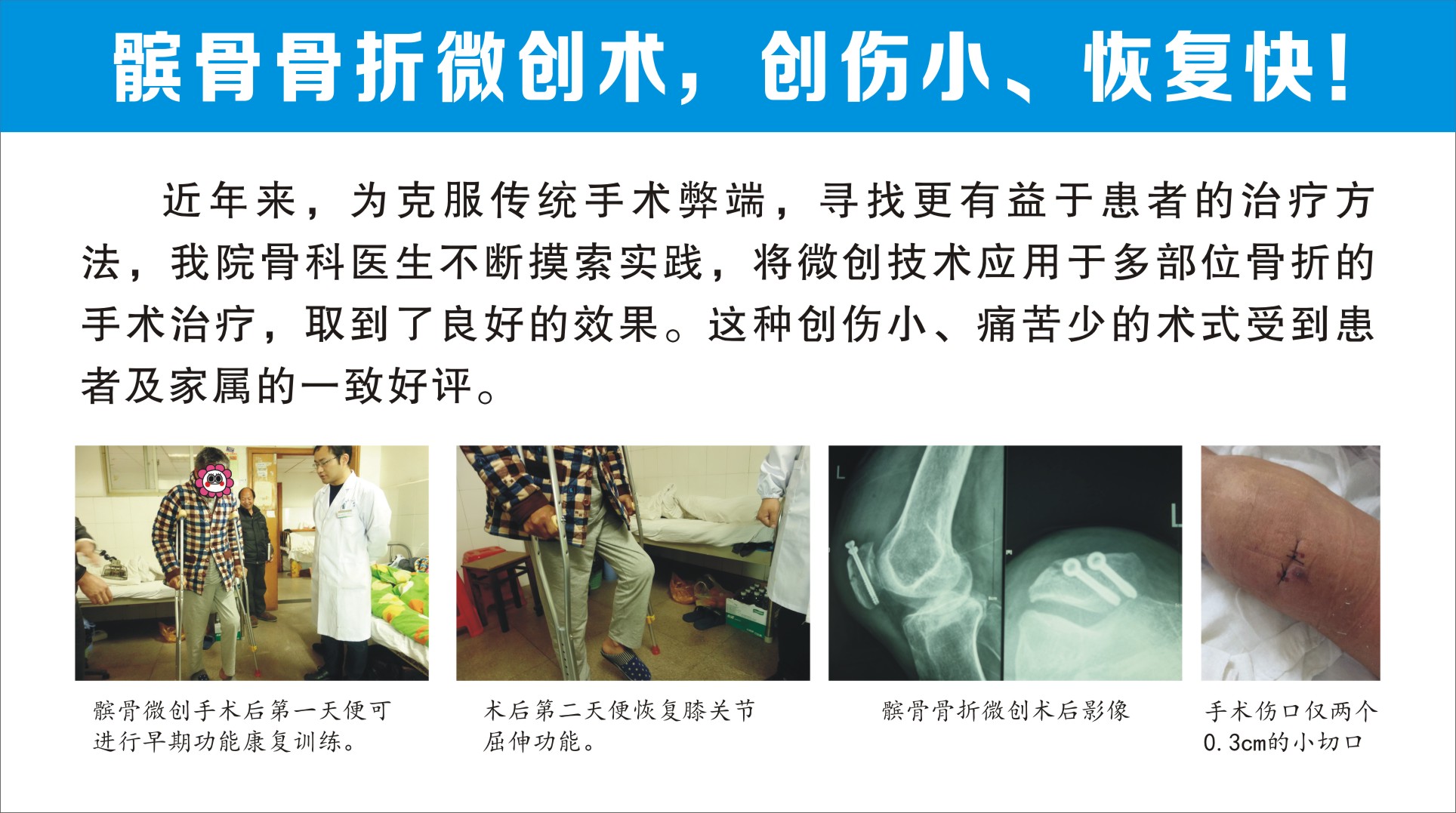 髌骨骨折微创术.jpg