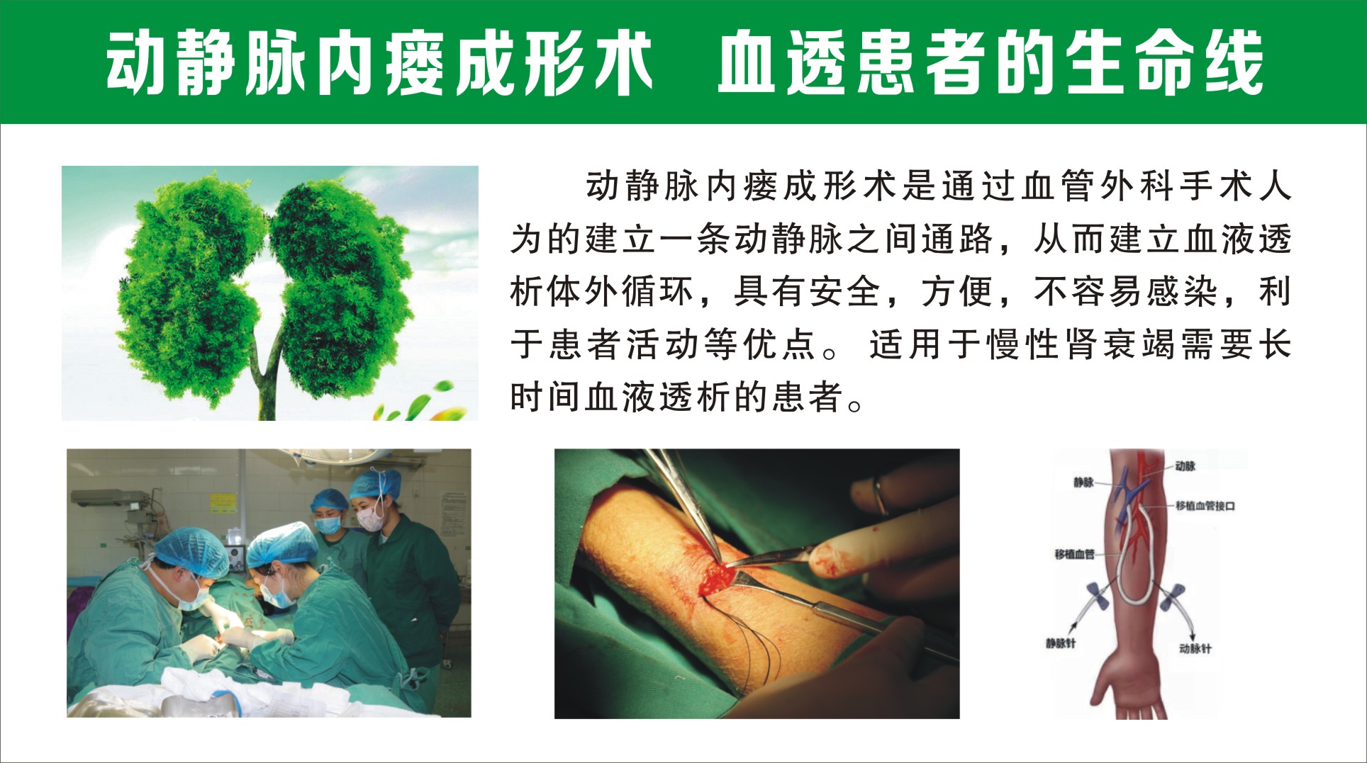 动静脉内瘘成形术.jpg